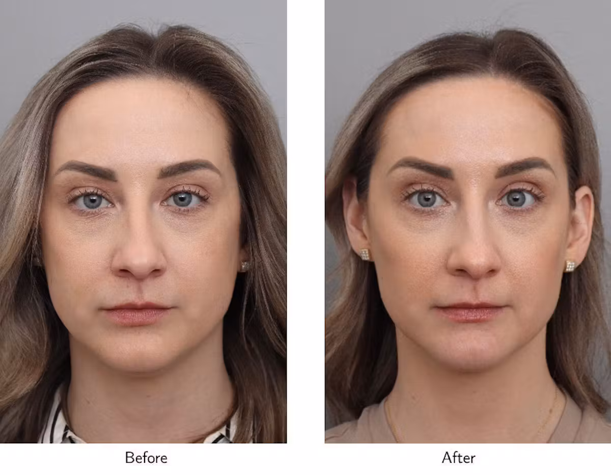 Non-Surgical Face Lift2.avif